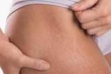 Are You Making Effective Use Of Stretch Mark Cream?