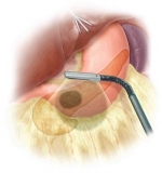 Intraoperative Ultrasound Market 2019- Global Industry Details by Overview, Size, Top Manufacturers, Trends, Demand, Overview, Forecast to 2025